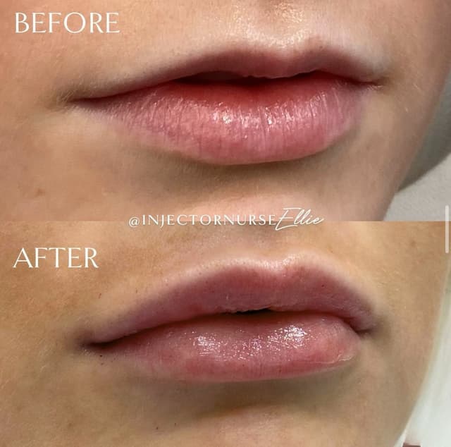 Lip filler injection before and after