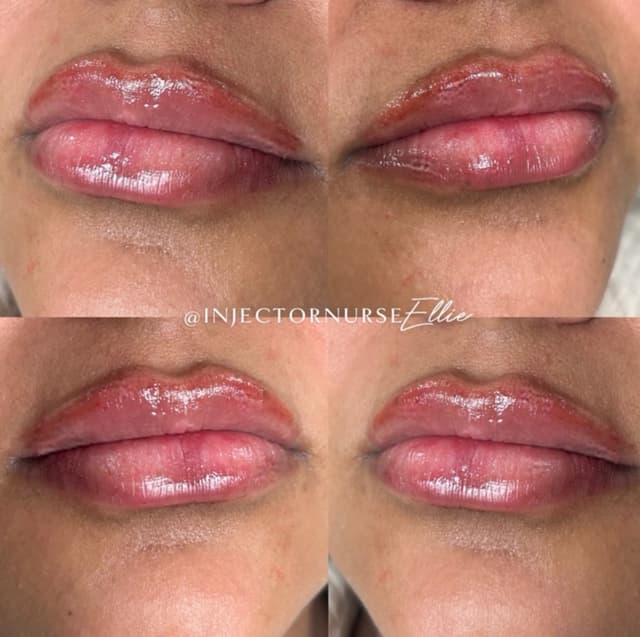 lip filler before and after