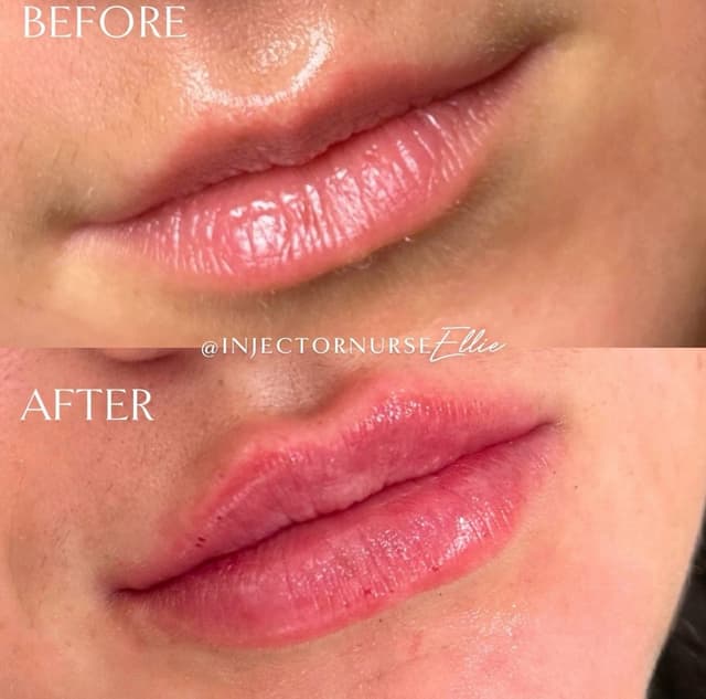 Lip filler injection before and after