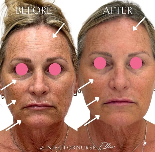 Full face rejuvenation addressing nasolabial folds and midface volume Woodland Hills.